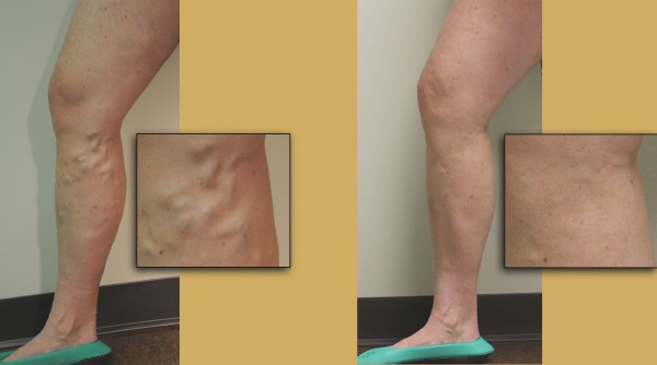 What are causes of leaking veins in the legs?
