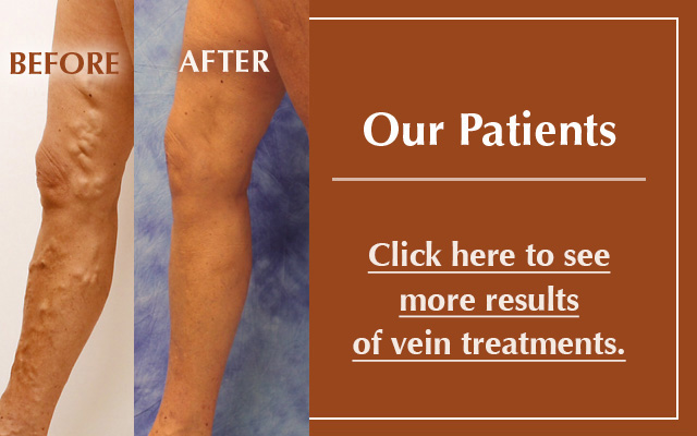 What are causes of leaking veins in the legs?