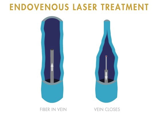 Endovenous Laser Ablation procedure for varicose veins at Vein Healthcare Center in South Portland, Maine