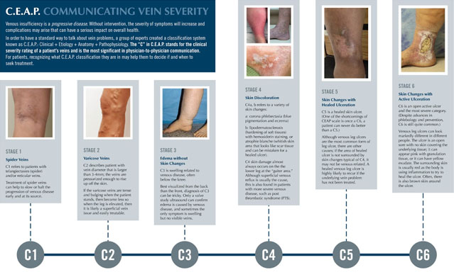 This Underdiagnosed Vein Disorder What You Need To Know - d6kq3ly